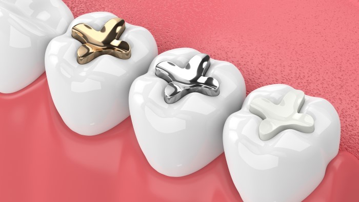 Diagram of gold, silver, and composite resin dental fillings.